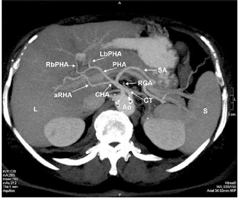 Dual Phase Helical Ct Transverse Scan On The L Level Ao Abdominal