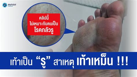 โรคเท้าเป็นรู ต้นเหตุทำให้เกิดเท้าเหม็น | พบหมอมหิดล [by Mahidol ...