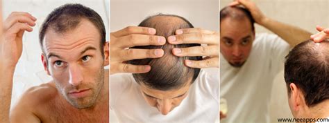 Best Hair Loss Treatment For Men Archives Nee Apps
