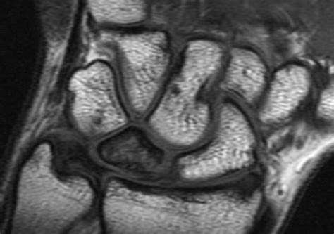 Kienbocks Disease Melbourne Hand Surgery