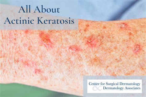Actinic Keratosis Vs Skin Cancer