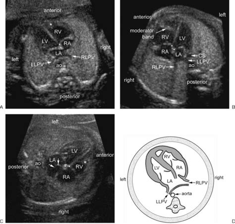 Normal Fetal Heart Ultrasound Images Evaluating Fetal Heart And Being