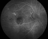 Photos of Ocular Histoplasmosis Treatment With Avastin