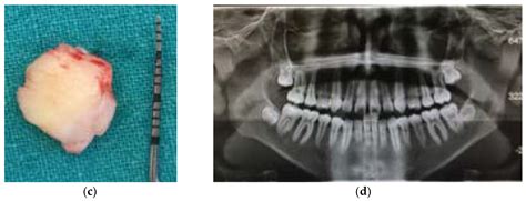 Dentistry Journal Free Full Text Efficacy Of Operculectomy In The