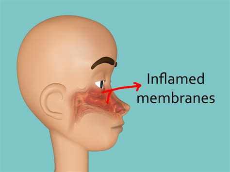 Tip your head back, pinch your nose and hold your breath. How to Get Rid of a Stuffy Nose Quickly (with Pictures ...
