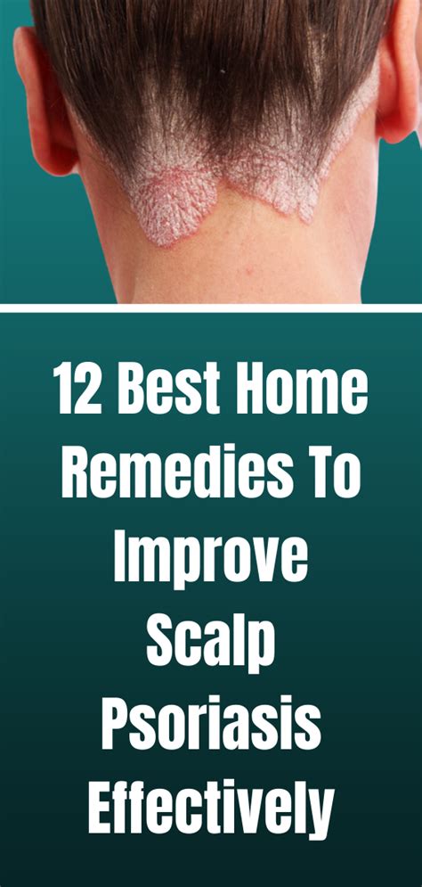 12 Best Home Remedies To Improve Scalp Psoriasis Effectively Scalp