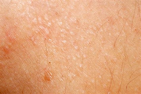 Dry Scaly Round Patches On Skin