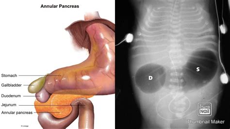 Annular Pancreas Whats That 😀😀 Double Bubble Sign 🤔🙄🤩 Sstomach