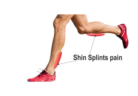 Physiotherapy For Shin Splints Pain Physiotherapy Surrey Seva