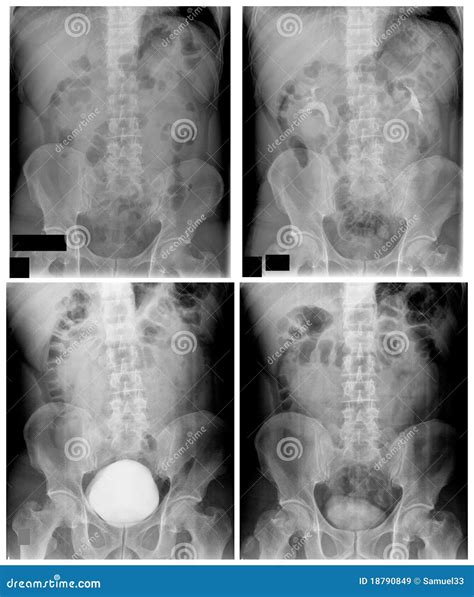 Ivp Pyelogram Of Patient With Kidney Stone Royalty Free Stock Images