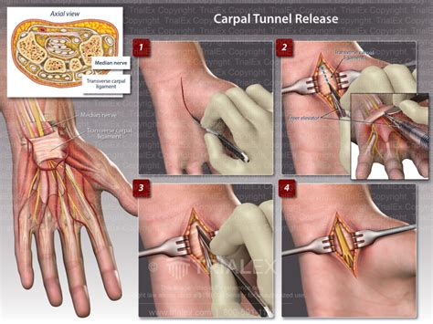 Carpal Tunnel Release Trialexhibits Inc