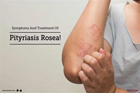 symptoms and treatment of pityriasis rosea by dr saravanan b n lybrate