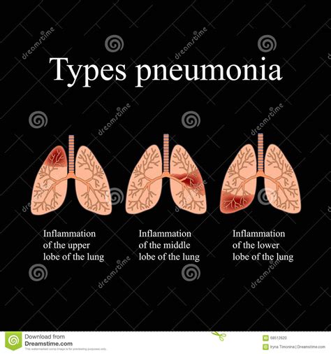 Pneumonia The Anatomical Structure Of The Human Lung