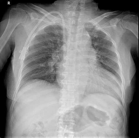 Initial Chest X Ray Image Showing Cardiomegaly With No Active Lung