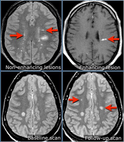 Mri is used in three ways for multiple sclerosis. The Radiology Assistant : Multiple Sclerosis