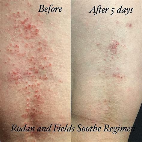Amanda Rodan Fields On Instagram “this Is Brendens Eczema And We