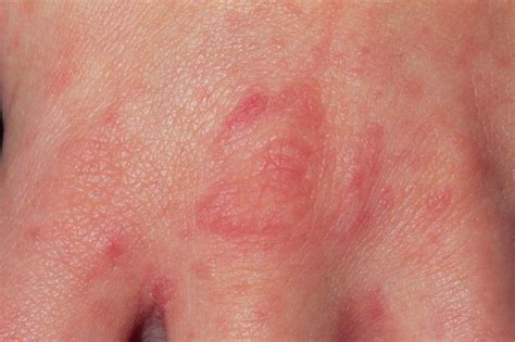 What Is Scabies Vrogue Co