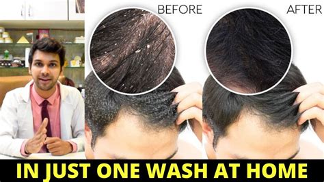 How To Clear Dandruff Permanently Dandruff And Hair Loss Natural