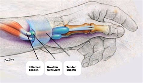 Adapted from the american society for surgery of the hand: De Quervain Syndrome / Tenosynovitis - Hand Pain Info