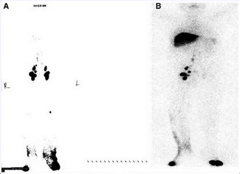 Preoperative A And Postoperative B Lymphoscintigraphy Of A Patient