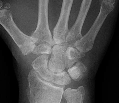 Thumb Carpometacarpal Suspension Arthroplasty Using Interference Screw