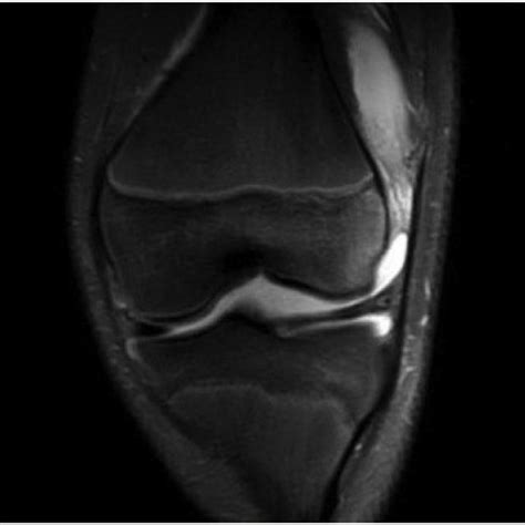 Mri Sagittal View Of The Left Knee Shows Marked Effusion Hematoma