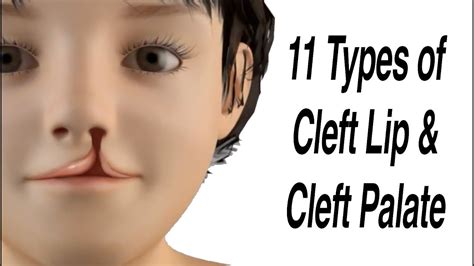 11 Types Of Cleft Lip And Cleft Palate YouTube