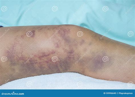 Closeup On A Bruise On Wounded Woman Leg Stock Photo Image Of Blow