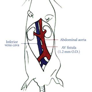 A Schematic Description Of The Creation Of Aortocaval Fistula Acf In