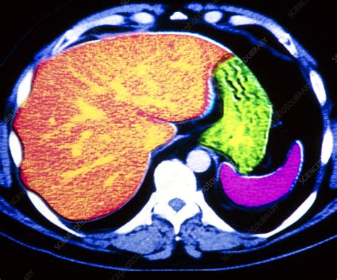 Coloured Ct Scan Of Human Spleen Stomach And Liver Stock Image P262