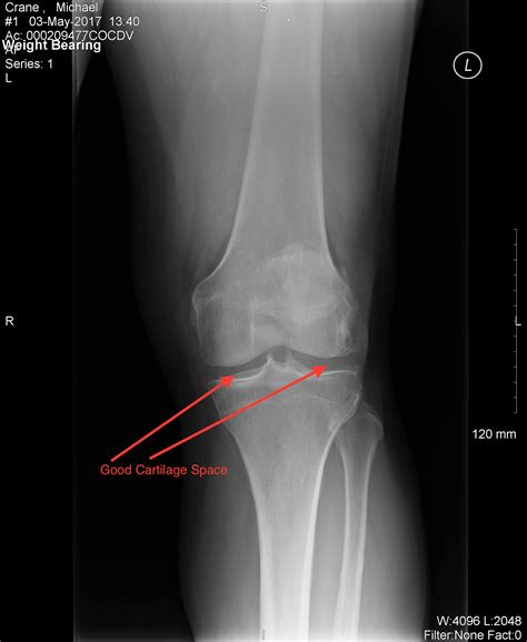 Knee Arthritis Knee And Hip Website