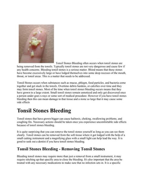 How Do You Get Tonsil Stones Eight Of The Most Common Causes