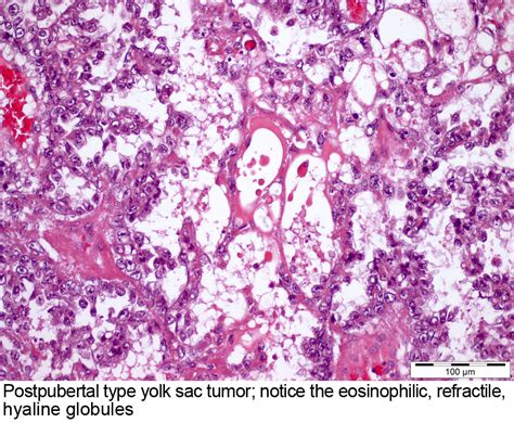 Pathology Outlines Yolk Sac Tumor