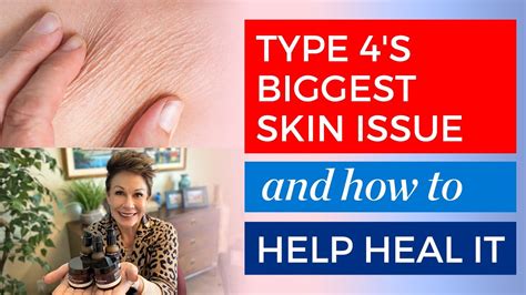 Type 4 How To Treat Crepey Skin Naturally Carol Tuttle Youtube