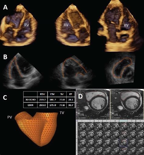 Automated Quantification Of Right Ventricular Size And Systolic