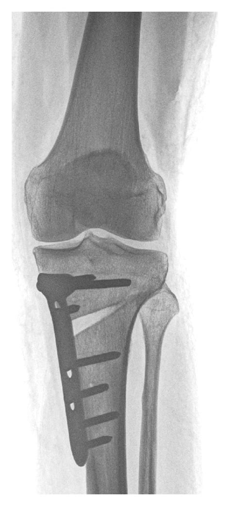 Unloading Osteotomy Exemplary A Valgisation Open Wedge High Tibial