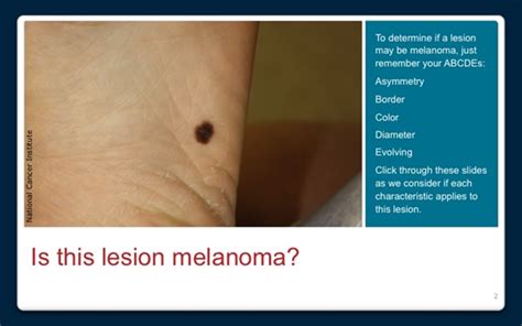 Learn The Signs Of Melanoma
