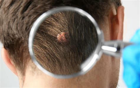 Moles On Scalp Causes And Treatments Beverly Hills Md