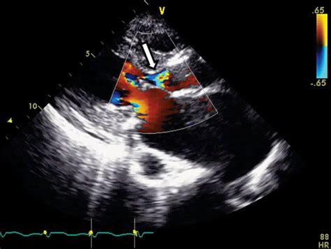 Paravalvular Aortic Leak After Transcatheter Aortic Valve Replacement