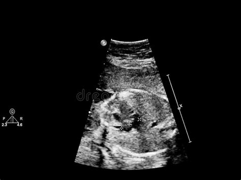 Ultrasound Screen With Fetal Echocardiography Stock Photo Image Of