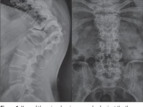 Figure 1 From Ligamentum Flavum Hypertrophy In A Patient With Potts Disease Semantic Scholar