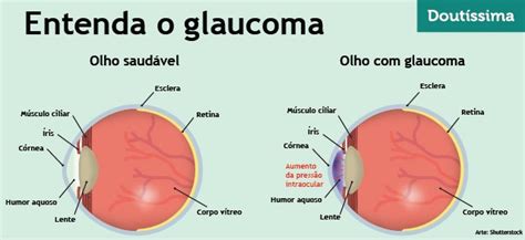Saiba O Que é Glaucoma E Como Tratar