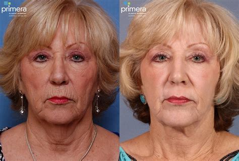 Facelift Before And After Pictures Case 118 Orlando Florida
