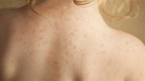 घरेलु नुस्खा लाइव गर्मी में एलर्जी घमोरी से कैसे बचें Home Remedy
