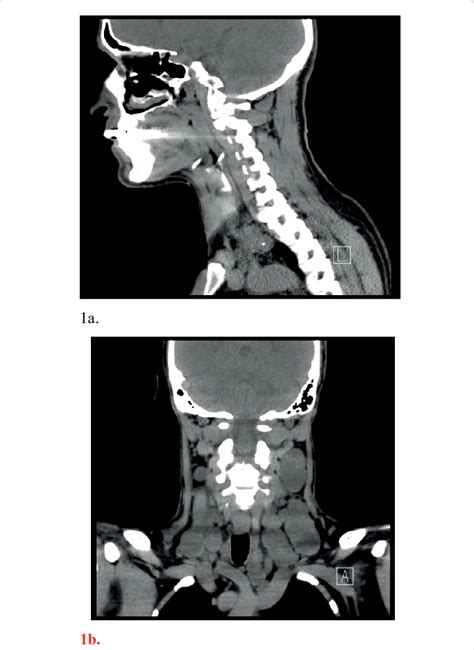 A And 1b The Ct Scan Neck Confirmed The Presence Of Bilateral Large