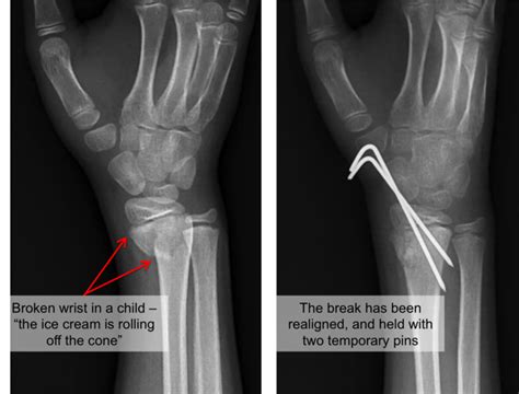 How To Treat A Broken Wrist Raleigh Orthopaedic