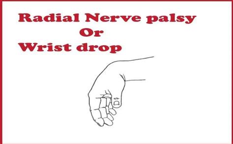 Radial Nerve Palsy Or Wrist Drop Learning Tree