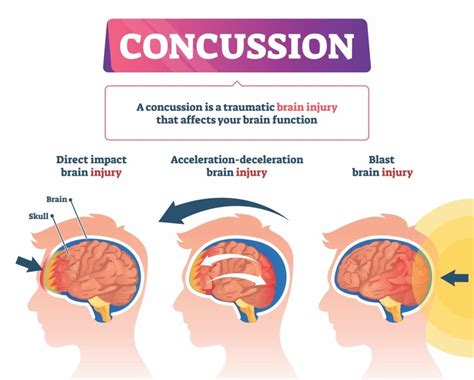 Concussion Neuphysio