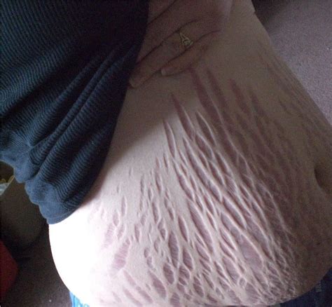 31 Best Stretch Mark Tattoo Camouflage Before And After Image Ideas