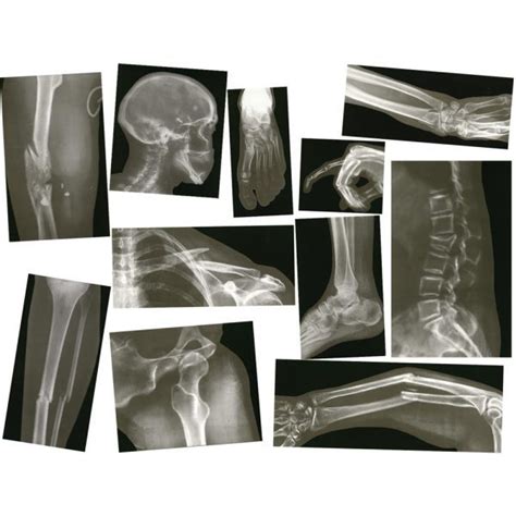 Broken Bones X Rays Biologylife Science Educational
